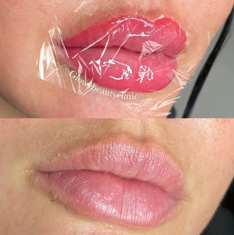 Läppigmentering före och efter — Glowy Beauty Clinic