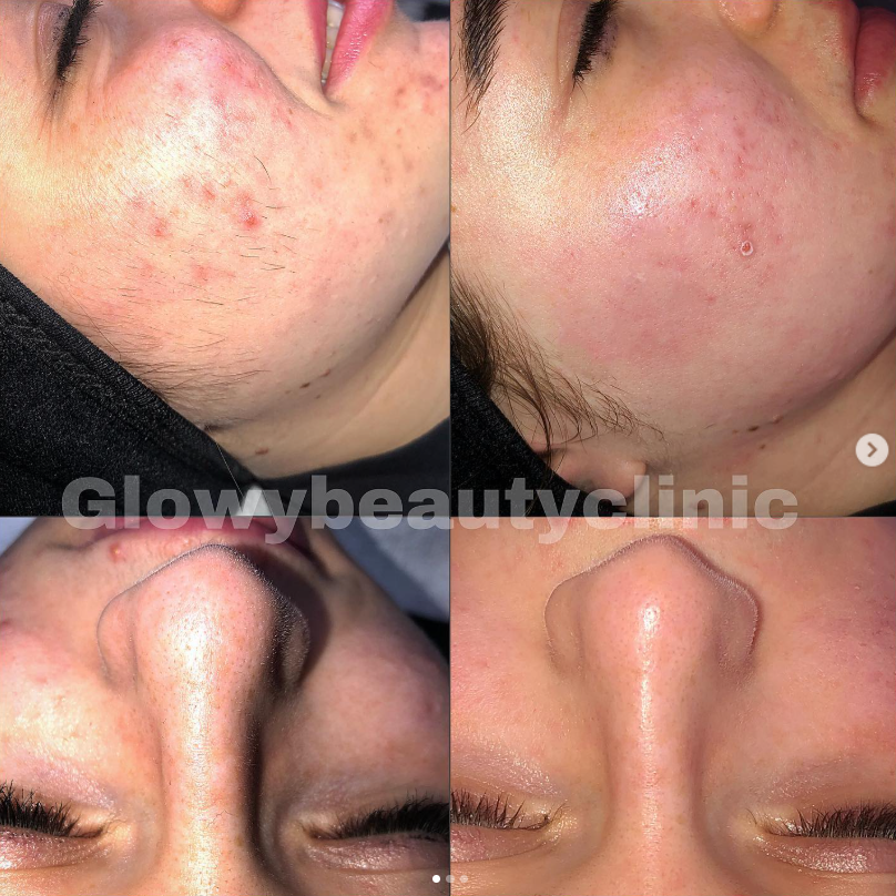 Hudvårdsresultat akne — Glowy Beauty Clinic