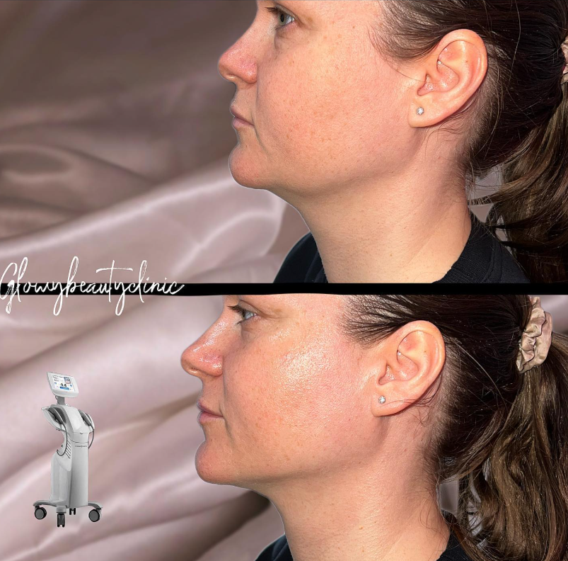HIFU käklinje före och efter — Glowy Beauty Clinic