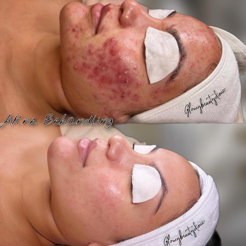 Akne behandling före och efter — Glowy Beauty Clinic
