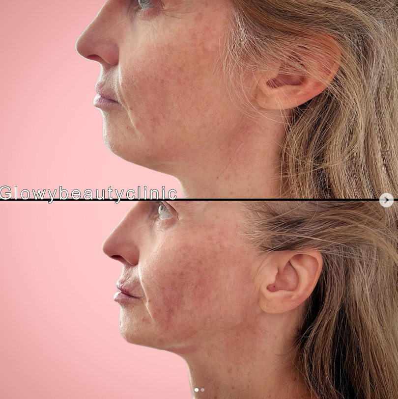 Hudföryngring resultat — Glowy Beauty Clinic